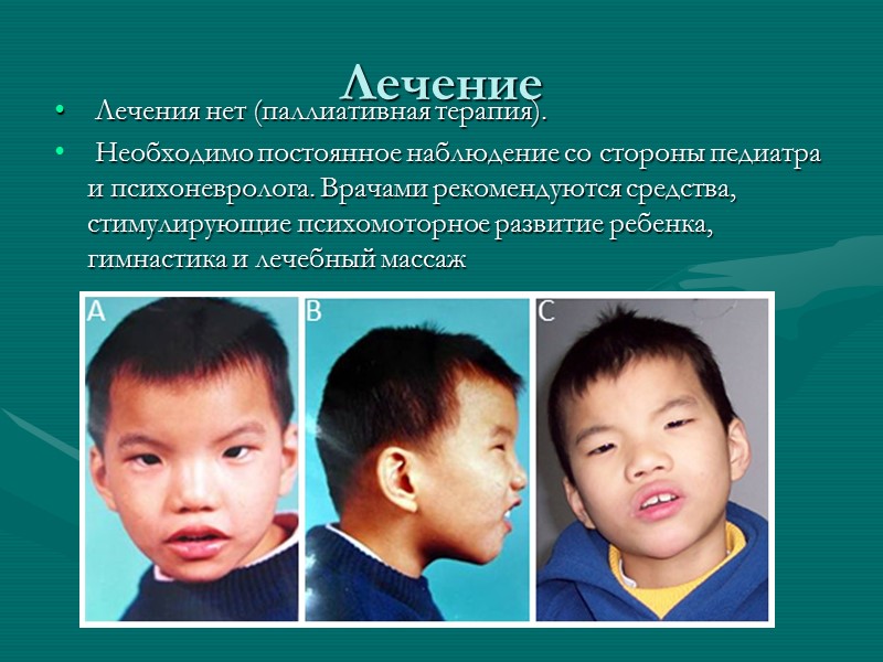 Лечение  Лечения нет (паллиативная терапия).  Необходимо постоянное наблюдение со стороны педиатра и